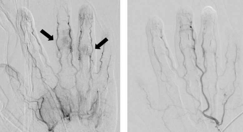 4栓塞前後對比照