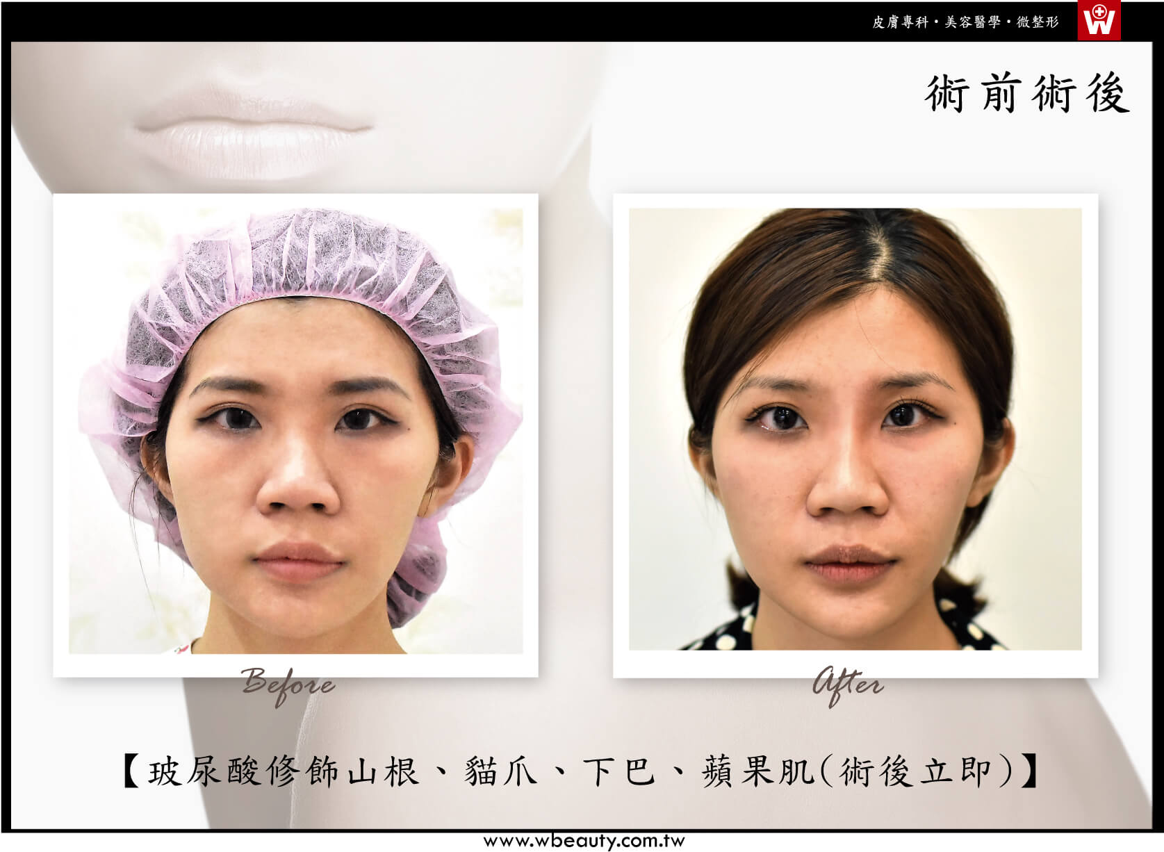 玻尿酸修飾山根貓爪下巴蘋果肌-術後立即