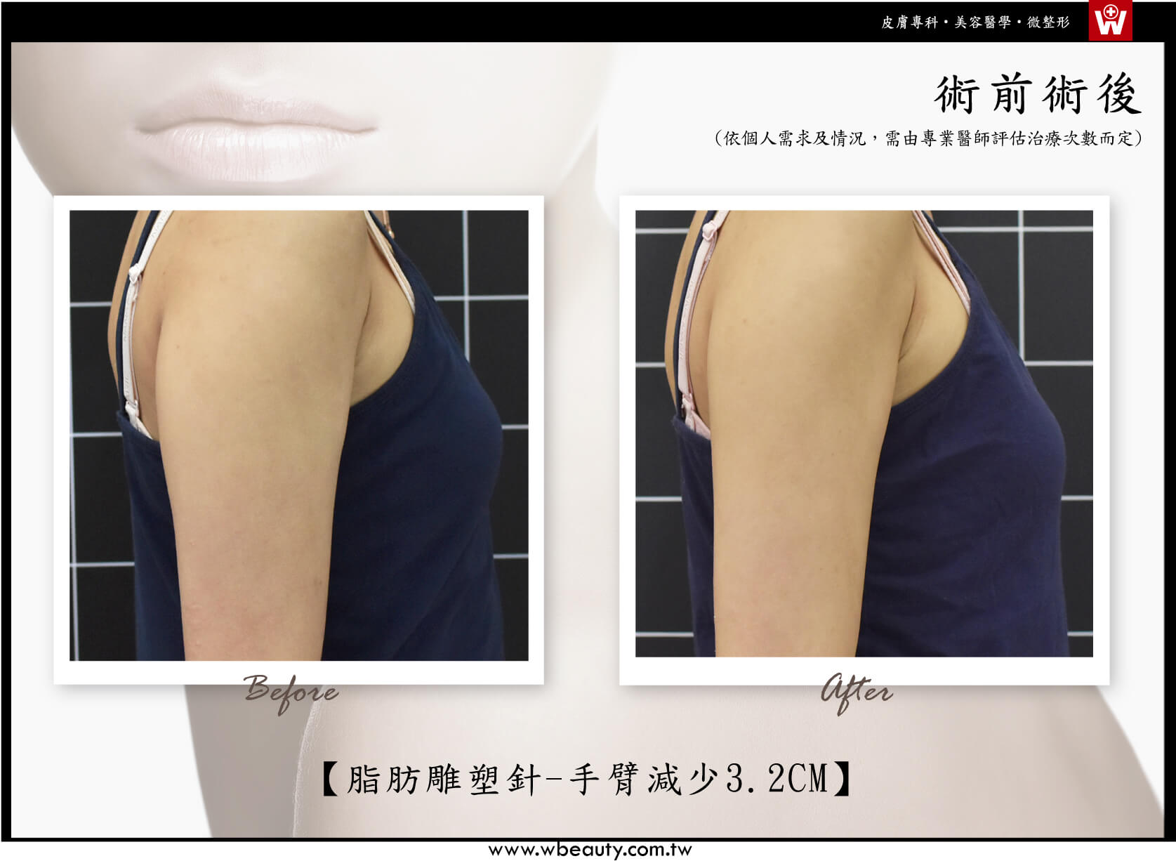 脂肪雕塑針-手臂術後減少3.2CM-2