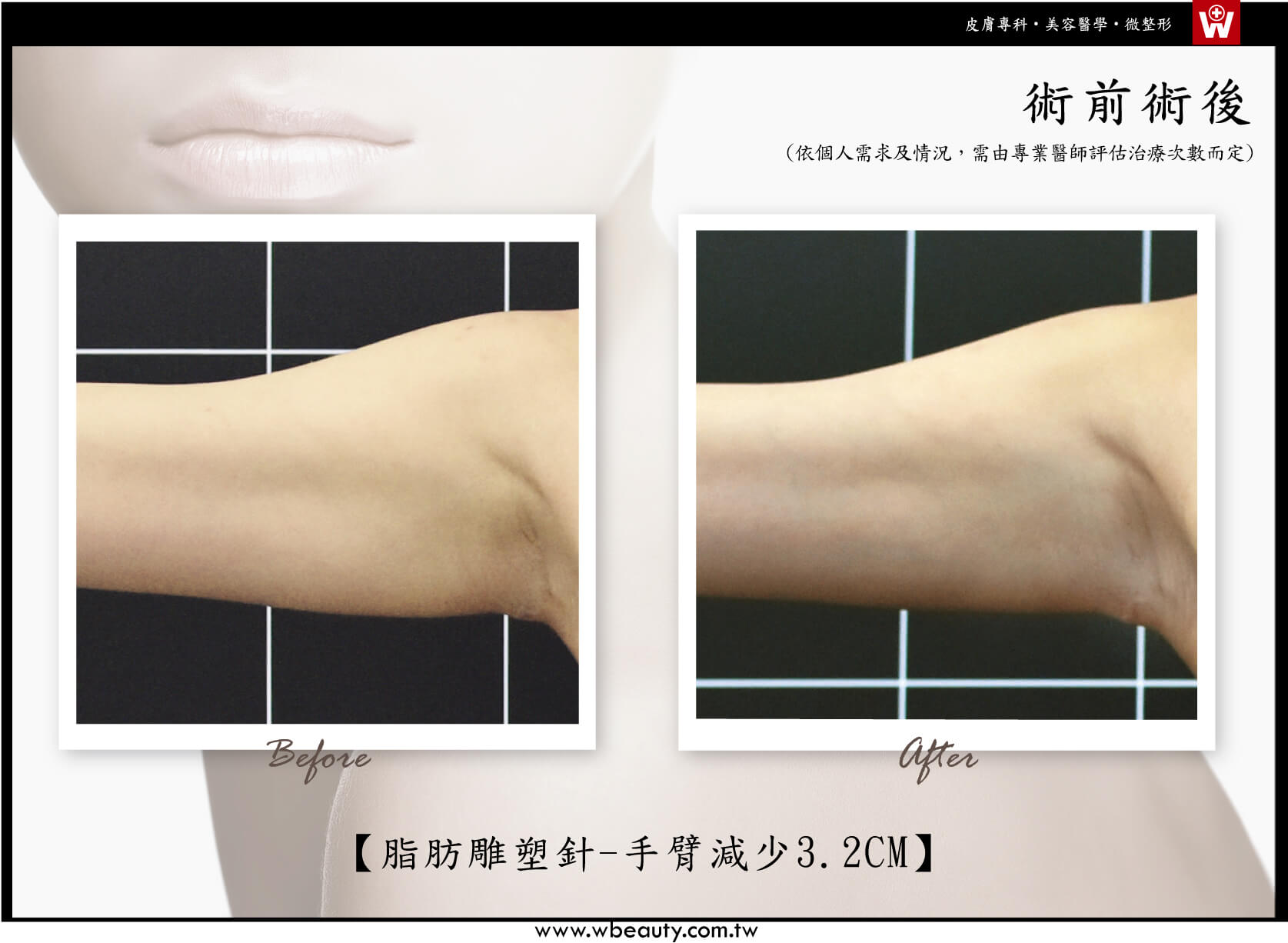 脂肪雕塑針-手臂術後減少3.2CM